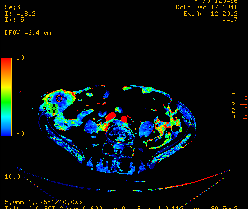 Imagerie De Perfusion Radiologie Et Imagerie Médicale Tzanck