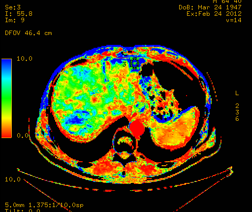 Imagerie De Perfusion Radiologie Et Imagerie Médicale Tzanck